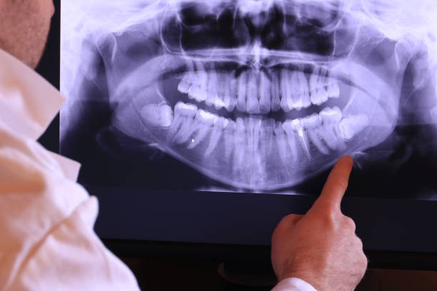 Best Emergency Dentist for Lost Fillings or Crowns in Nibley, UT